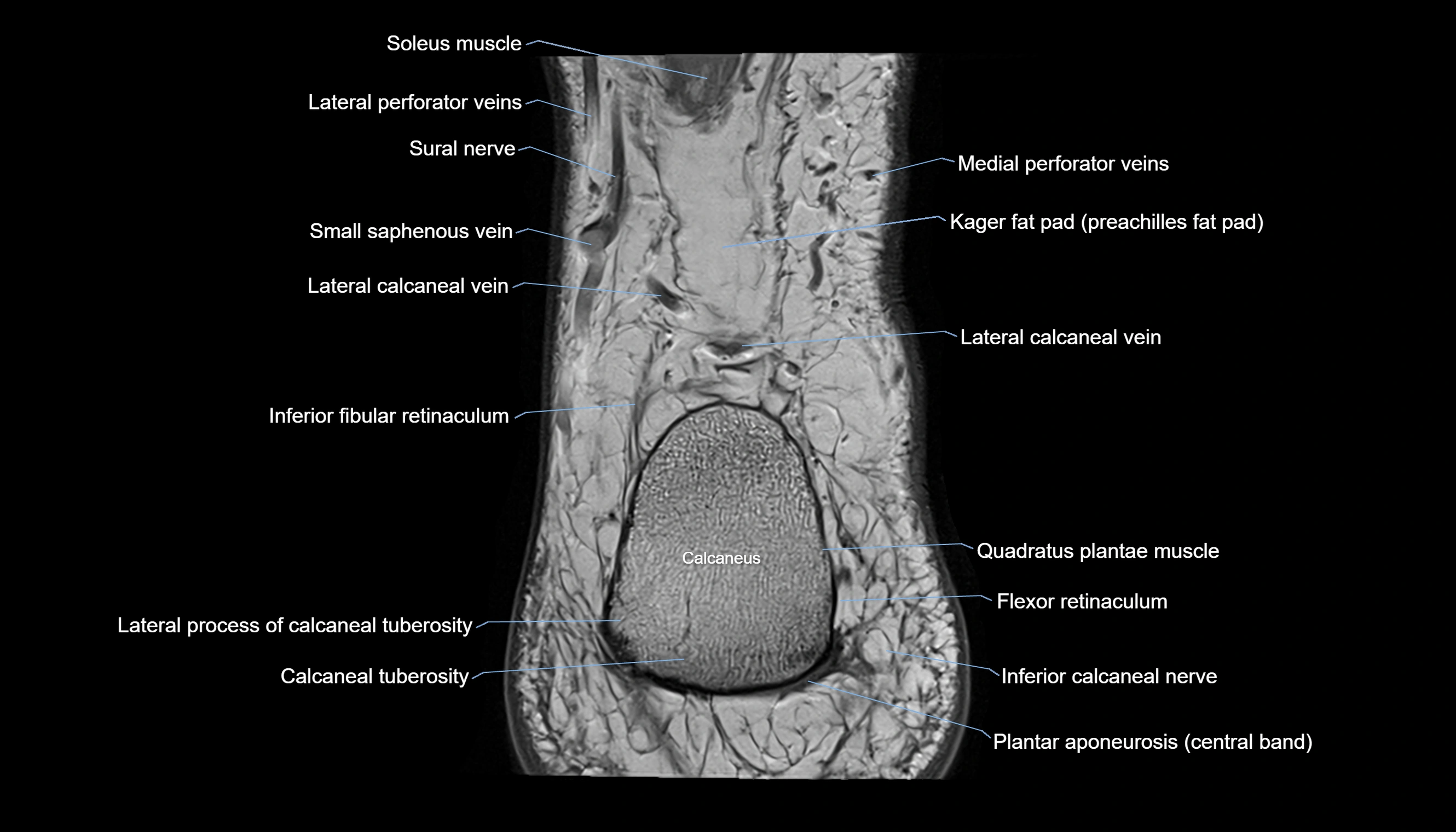 Ankle coronal anatomy 3T MRI images -img-11001-00027.webp
